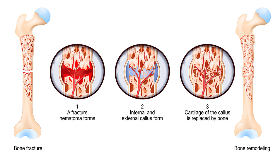 Stages of bone healing