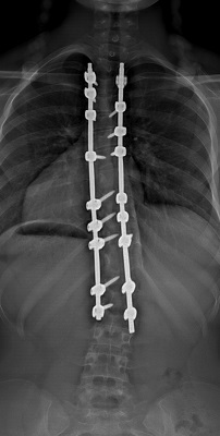 EOS scan of Emily’s spine after surgery