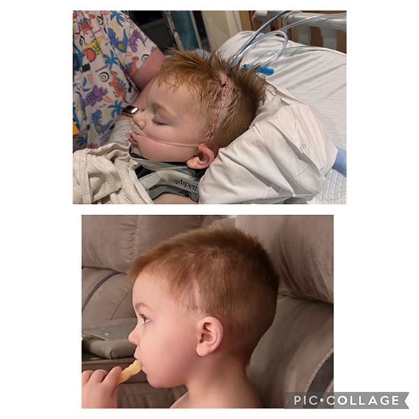 CHoR patient Linwood immediately following brain surgery and a few months later