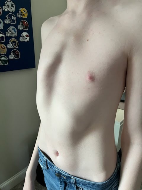 teen with chest wall deformity prior to surgery